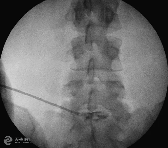 腰椎神經(jīng)根性病變