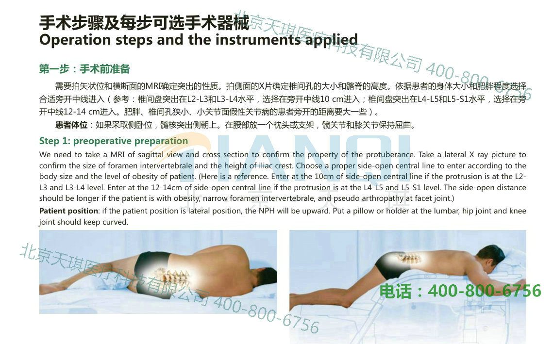 椎間孔鏡手術(shù)步驟